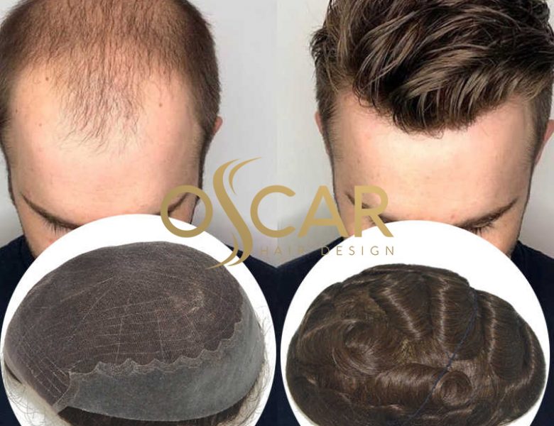 Kellik Tedavisi İçin En Doğal Protez Saç Çeşitleri Oscar Hair Desing Farkıyla!